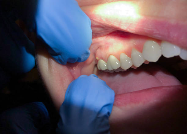 Best Emergency Wisdom Tooth Extraction in Copeland, OK